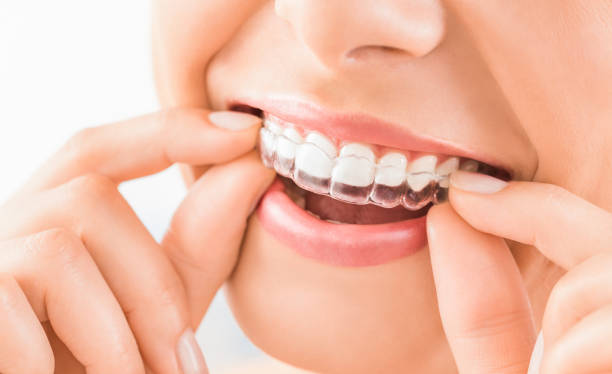 hand holding clear teeth aligners in mouth, Millbrae, CA Invisalign